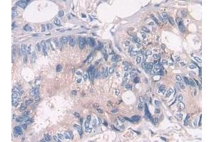 Detection of ATP6AP2 in Human Colorectal cancer Tissue using Polyclonal Antibody to ATPase, H+ Transporting, Lysosomal Accessory Protein 2 (ATP6AP2)