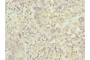 Immunohistochemistry of paraffin-embedded human liver cancer using ABIN7148371 at dilution of 1:100 (C8B anticorps  (AA 55-350))