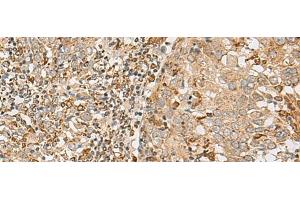 Immunohistochemistry of paraffin-embedded Human cervical cancer tissue using ZC3H7A Polyclonal Antibody at dilution of 1:50(x200)