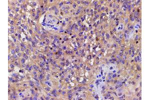 ABIN6267443 at 1/200 staining human meningeal carcinomatosis(MC) tissue sections by IHC-P.