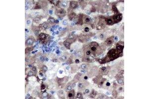 Immunohistochemical analysis of Geminin staining in human liver cancer formalin fixed paraffin embedded tissue section.