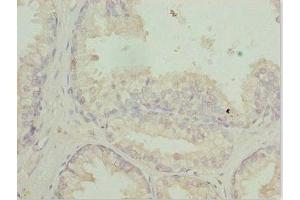 Immunohistochemistry of paraffin-embedded human prostate cancer using ABIN7167729 at dilution of 1:100 (RFPL2 anticorps  (AA 99-378))