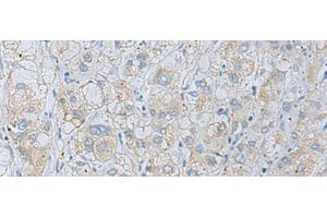 Immunohistochemistry of paraffin-embedded Human liver cancer tissue using NAGK Polyclonal Antibody at dilution of 1:35(x200)