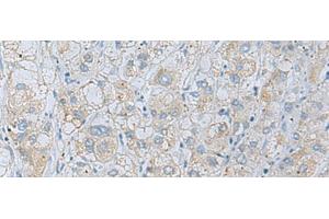 Immunohistochemistry of paraffin-embedded Human liver cancer tissue using NAGK Polyclonal Antibody at dilution of 1:35(x200) (NAGK anticorps)