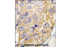 Formalin-fixed and paraffin-embedded human prostata carcinoma tissue reacted with DRAGON (RGMB) , which was peroxidase-conjugated to the secondary antibody, followed by DAB staining. (RGMB anticorps  (C-Term))