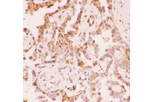 Anti-SIRT2 Picoband antibody,  IHC(P): Human Lung Cancer Tissue