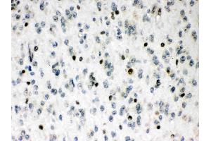 MEF2A was detected in paraffin-embedded sections of human glioma tissues using rabbit anti- MEF2A Antigen Affinity purified polyclonal antibody (Catalog # ) at 1 µg/mL. (MEF2A anticorps  (C-Term))