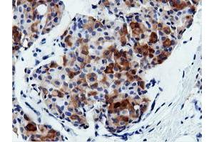 Immunohistochemical staining of paraffin-embedded Adenocarcinoma of Human breast tissue using anti-AK5 mouse monoclonal antibody. (Adenylate Kinase 5 anticorps)