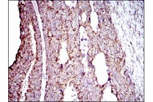 Immunohistochemical analysis of paraffin-embedded rectum cancer tissues using ALDH2 mouse mAb with DAB staining. (ALDH2 anticorps  (AA 317-517))