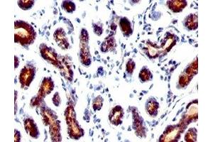 Formalin-fixed, paraffin-embedded human breast carcinoma stained with TFF1 antibody. (TFF1 anticorps  (C-Term))