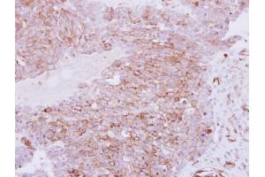 IHC-P Image Immunohistochemical analysis of paraffin-embedded human ovarian carcinoma, using RhoC, antibody at 1:250 dilution. (RHOC anticorps)