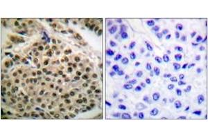 Immunohistochemistry analysis of paraffin-embedded human breast carcinoma, using NF-kappaB p105/p50 (Phospho-Ser927) Antibody. (NFKB1 anticorps  (pSer927))
