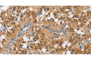 Immunohistochemistry of paraffin-embedded Human thyroid cancer tissue using CUL7 Polyclonal Antibody at dilution 1:50 (Cullin 7 anticorps)