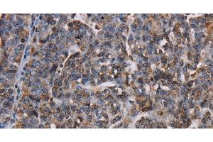 Immunohistochemistry of paraffin-embedded Human ovarian cancer using LBR Polyclonal Antibody at dilution of 1:50