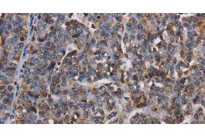 Immunohistochemistry of paraffin-embedded Human ovarian cancer using LBR Polyclonal Antibody at dilution of 1:50 (Lamin B Receptor anticorps)
