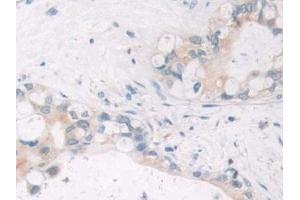 Detection of SIRT4 in Human Bile duct cancer Tissue using Polyclonal Antibody to Sirtuin 4 (SIRT4)