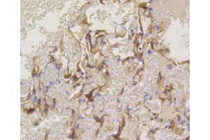Immunohistochemistry of paraffin-embedded human lung using PRKCA antibody (ABIN4904772) at dilution of 1:100 (40x lens). (PKC alpha anticorps)