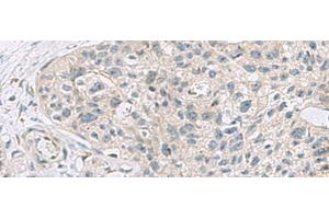 Immunohistochemistry of paraffin-embedded Human esophagus cancer tissue using ABCA10 Polyclonal Antibody at dilution of 1:50(x200) (ABCA10 anticorps)