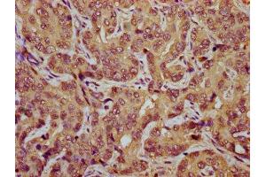 IHC image of ABIN7171794 diluted at 1:800 and staining in paraffin-embedded human liver cancer performed on a Leica BondTM system. (TES anticorps  (AA 130-260))