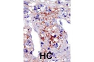 Formalin-fixed and paraffin-embedded human cancer tissue reacted with the primary antibody, which was peroxidase-conjugated to the secondary antibody, followed by AEC staining. (PIP5K1C anticorps  (N-Term))