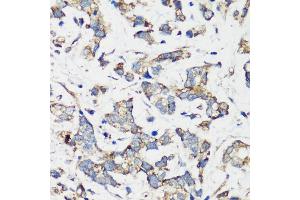 Immunohistochemistry of paraffin-embedded human gastric cancer using TSC1 antibody (ABIN6133755, ABIN6149609, ABIN6149610 and ABIN6213968) at dilution of 1:200 (40x lens).