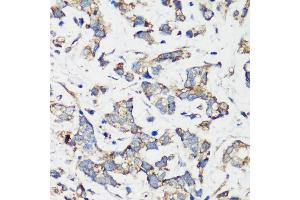 Immunohistochemistry of paraffin-embedded human gastric cancer using TSC1 antibody (ABIN6133755, ABIN6149609, ABIN6149610 and ABIN6213968) at dilution of 1:200 (40x lens). (TSC1 anticorps  (AA 550-650))