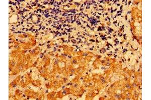 Immunohistochemistry of paraffin-embedded human liver cancer using ABIN7147612 at dilution of 1:100 (CHDH anticorps  (AA 30-223))