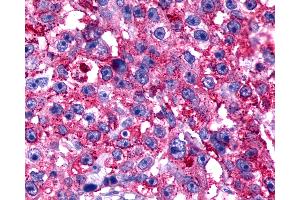 Anti-TPRA1 / GPR175 antibody IHC of human Breast, Carcinoma.