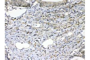 IHC testing of FFPE human intestinal cancer tissue with VEGFR2 antibody at 1ug/ml.