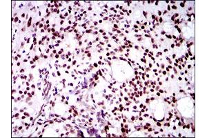 Immunohistochemical analysis of paraffin-embedded cervical cancer tissues using TWIST1 mouse mAb with DAB staining.