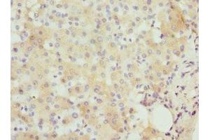Immunohistochemistry of paraffin-embedded human liver cancer using ABIN7156584 at dilution of 1:100