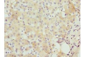Immunohistochemistry of paraffin-embedded human liver cancer using ABIN7156584 at dilution of 1:100 (IFNB1 anticorps  (AA 22-187))