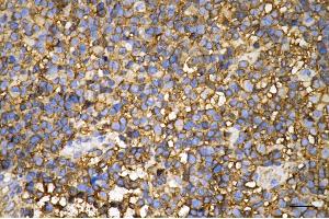 Immunohistochemistry was performed on paraffin-embedded human glioblastoma using pannexin 1 antibody (ABIN7799733), 1:200). (Recombinant PANX1 anticorps)