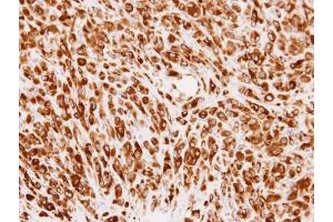 IHC-P Image Immunohistochemical analysis of paraffin-embedded U87 xenograft, using PMM2, antibody at 1:100 dilution.