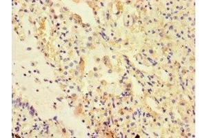Immunohistochemistry of paraffin-embedded human lung cancer using ABIN7175178 at dilution of 1:100 (UVRAG anticorps  (AA 375-425))