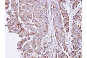 IHC-P Image Immunohistochemical analysis of paraffin-embedded OVCAR3 xenograft , using SGSH, antibody at 1:100 dilution.
