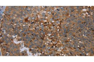 Immunohistochemistry of paraffin-embedded Human cervical cancer tissue using OTOR Polyclonal Antibody at dilution 1:30 (Otoraplin anticorps)