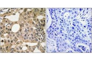 Immunohistochemistry analysis of paraffin-embedded human breast carcinoma tissue, using BCL-XL (Ab-115) Antibody. (BCL2L1 anticorps  (AA 81-130))