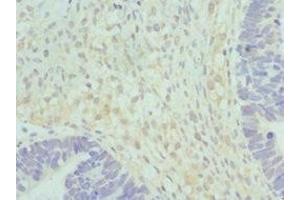 Immunohistochemistry of paraffin-embedded human ovarian cancer using ABIN7152037 at dilution of 1:100 (HSD17B2 anticorps  (AA 118-387))