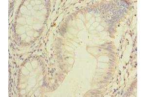 Immunohistochemistry of paraffin-embedded human colon cancer using ABIN7168953 at dilution of 1:100 (C7orf45 anticorps  (AA 56-244))