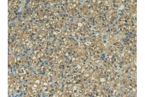 Detection of MMP13 in Human Renal cancer Tissue using Polyclonal Antibody to Matrix Metalloproteinase 13 (MMP13)