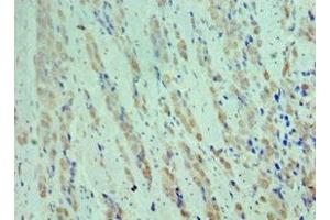 Immunohistochemistry of paraffin-embedded human colon cancer using ABIN7148906 at dilution of 1:100