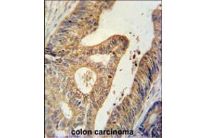 BTG1 Antibody immunohistochemistry analysis in formalin fixed and paraffin embedded human colon carcinoma followed by peroxidase conjugation of the secondary antibody and DAB staining. (BTG1 anticorps  (AA 92-118))