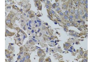 Immunohistochemistry of paraffin-embedded human breast cancer using GNA15 antibody (ABIN5971107) at dilution of 1/100 (40x lens). (GNA15 anticorps)