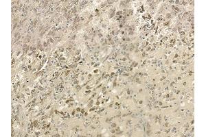 ABIN6261622 and ABIN6273240 at 1/100 staining human melanoma by IHC-P. (ETV5 anticorps  (Internal Region))