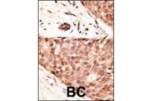 Formalin-fixed and paraffin-embedded human cancer tissue reacted with the primary antibody, which was peroxidase-conjugated to the secondary antibody, followed by AEC staining.