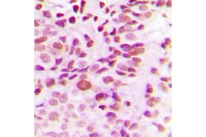 Immunohistochemical analysis of DNMT3B staining in human breast cancer formalin fixed paraffin embedded tissue section.