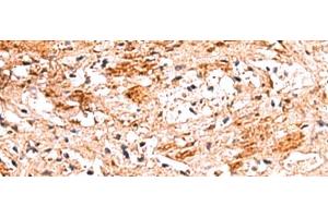 Immunohistochemistry of paraffin-embedded Human liver cancer tissue using NADK Polyclonal Antibody at dilution of 1:70(x200) (NADK anticorps)