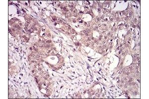Immunohistochemical analysis of paraffin-embedded human cervical cancer tissues using RANBP9 mouse mAb with DAB staining. (Importin 9 anticorps  (AA 453-680))