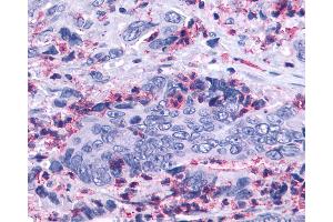 Anti-LTB4R2 / BLT2 antibody IHC of human Colon, Carcinoma and Leukocytes.